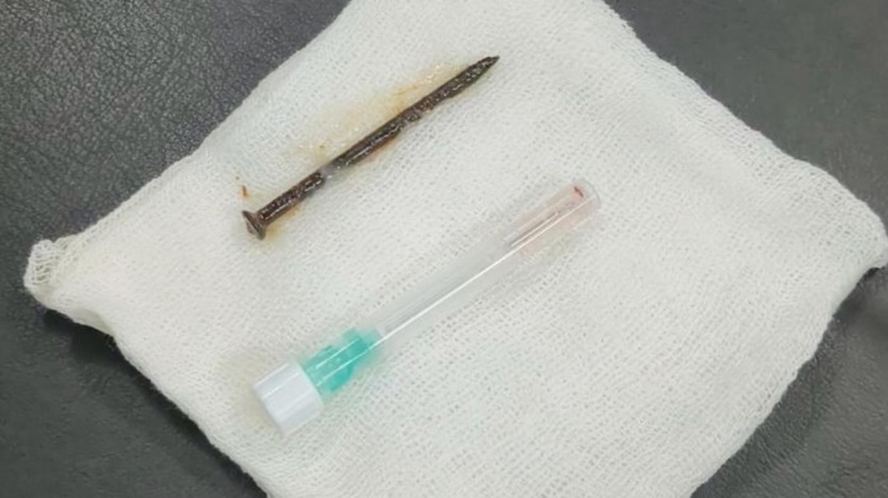 Warga Riau Tersedak Paku 5 cm Saat Perbaiki Kamar, Nyangkut di Paru-paru