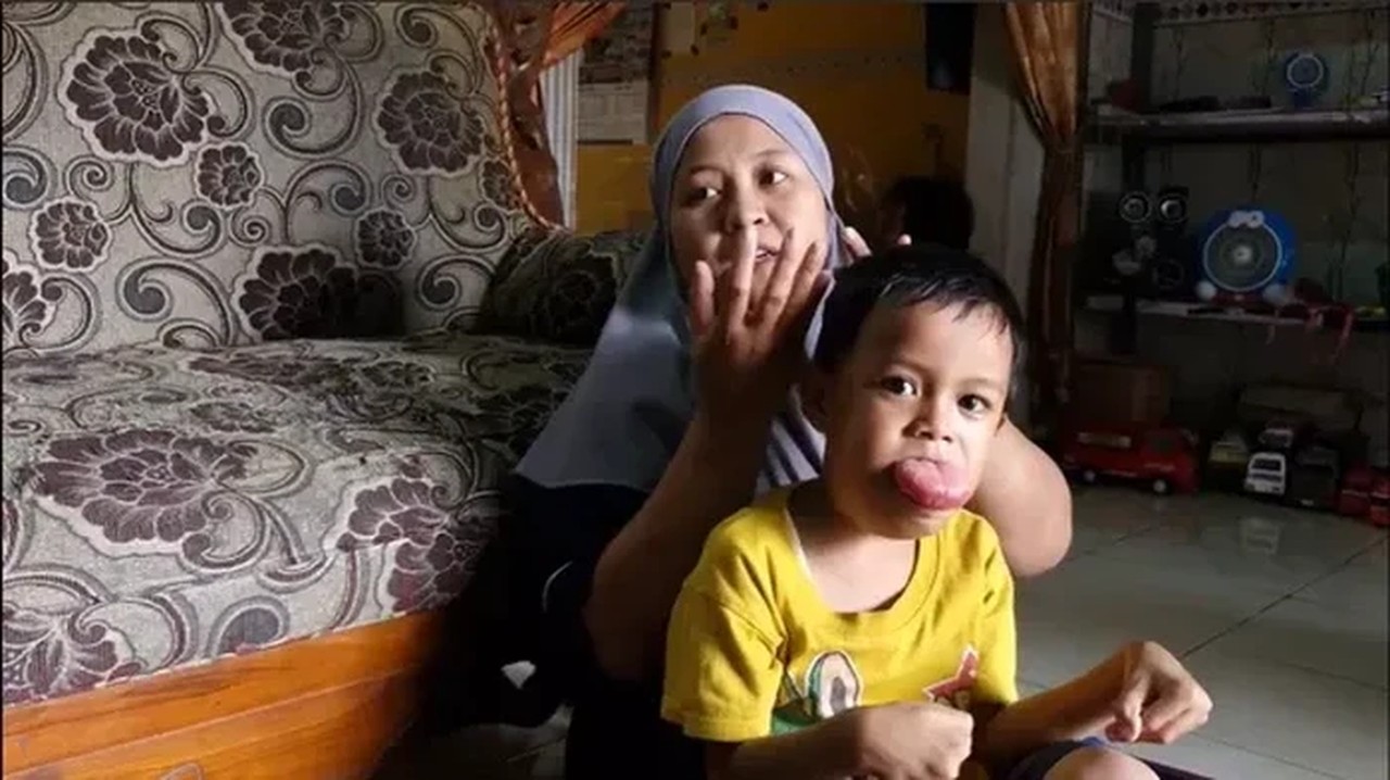 Febio, Bocah 6 Tahun Berjuang Melawan Tumor Lidah Sejak Lahir