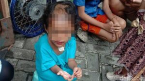 Balita di Surabaya Dianiaya dan Dibotaki Paman-Bibi, Polisi Dalami Motif