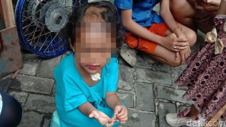 Balita di Surabaya Dianiaya dan Dibotaki Paman-Bibi, Polisi Dalami Motif