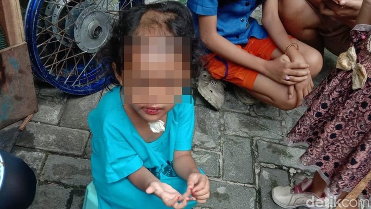 Balita di Surabaya Dianiaya dan Dibotaki Paman-Bibi, Polisi Dalami Motif